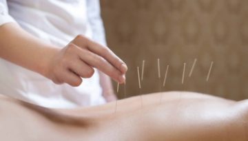 Acupuncture